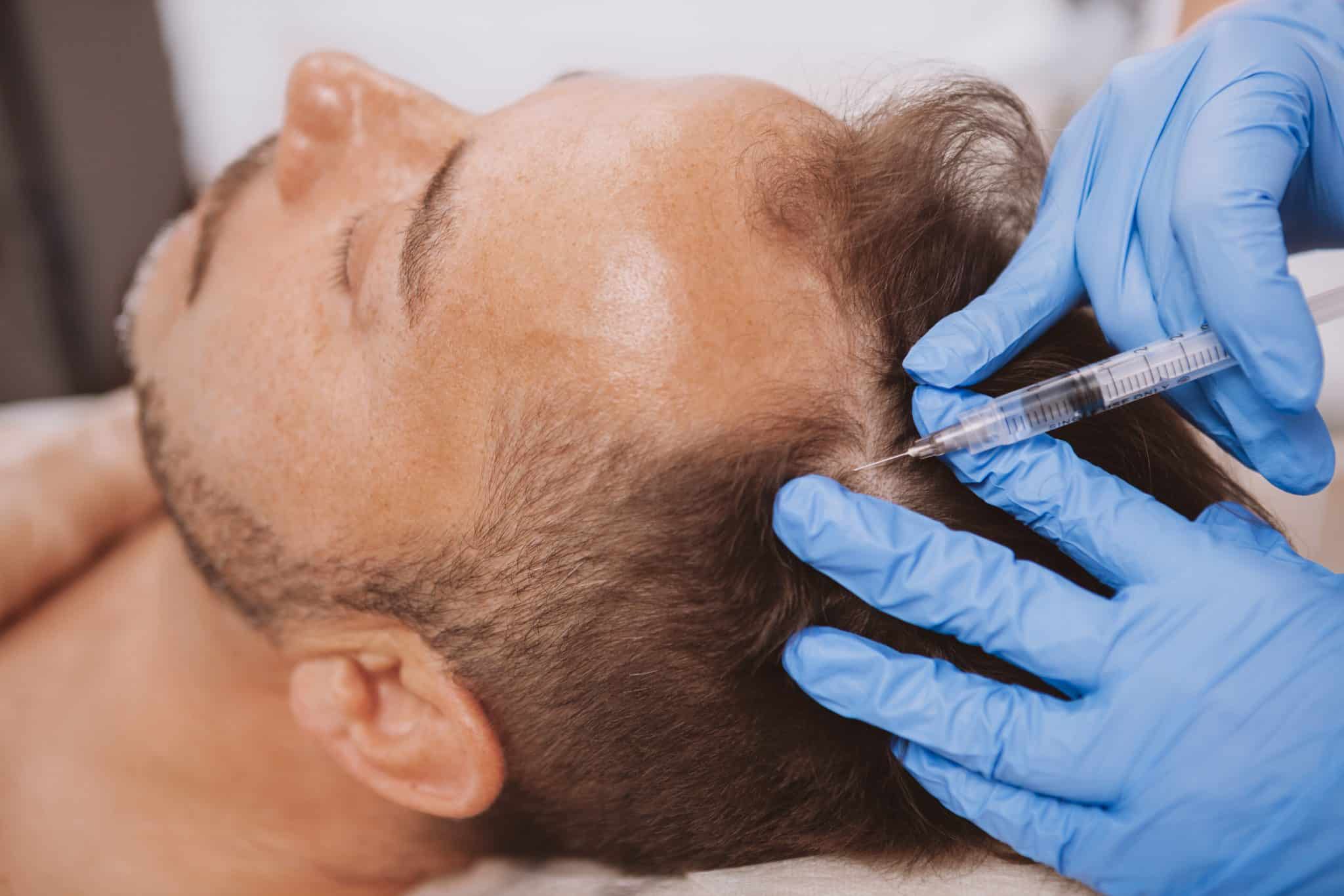 Man Receiving Hair Loss Treatment