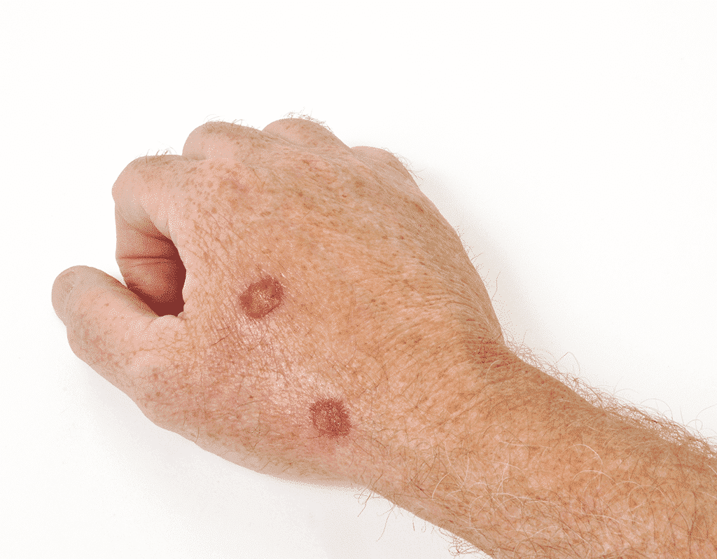 Actinic Keratosis on a patient's hand