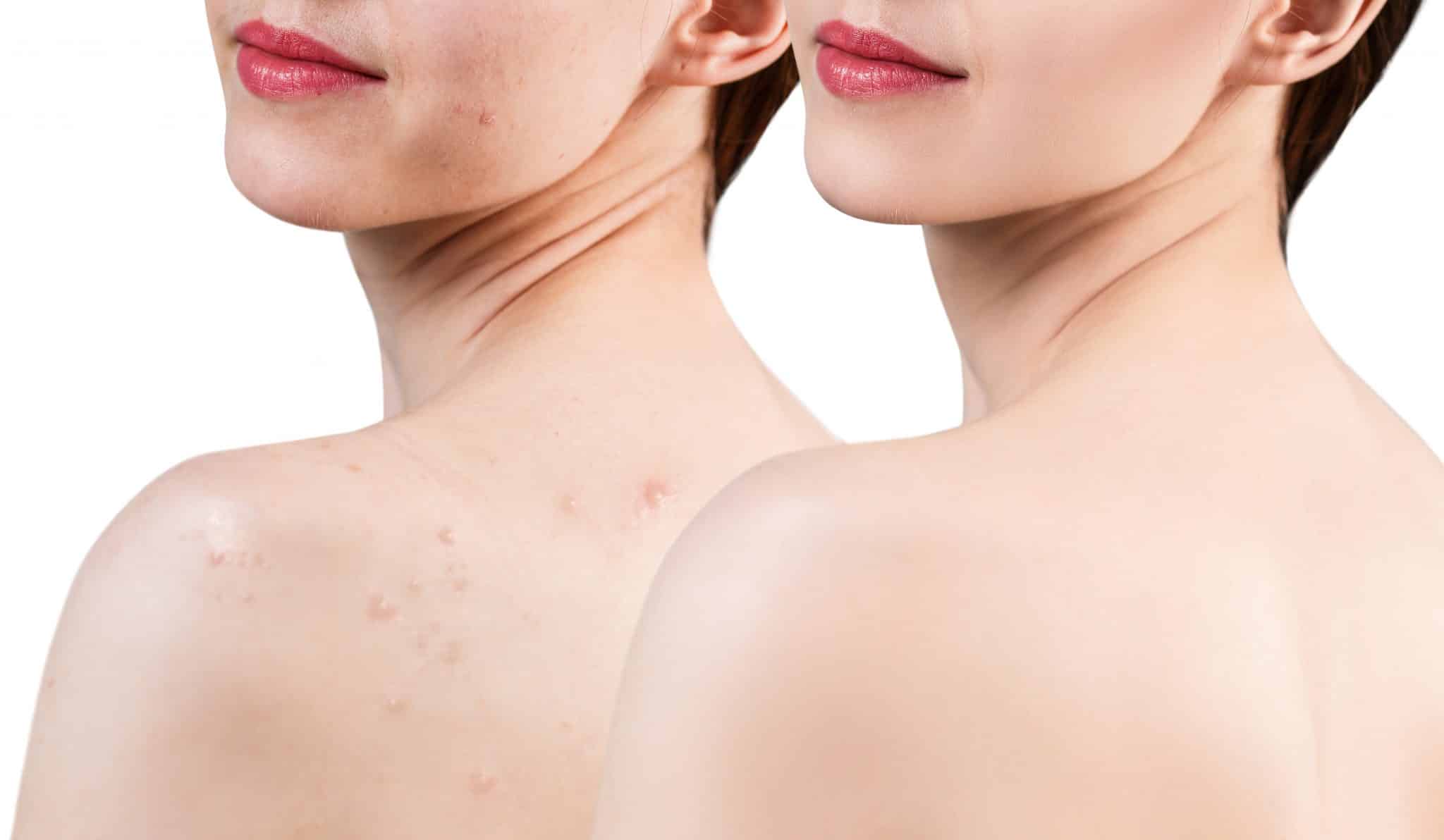 How to Get Rid of Back Acne Scars