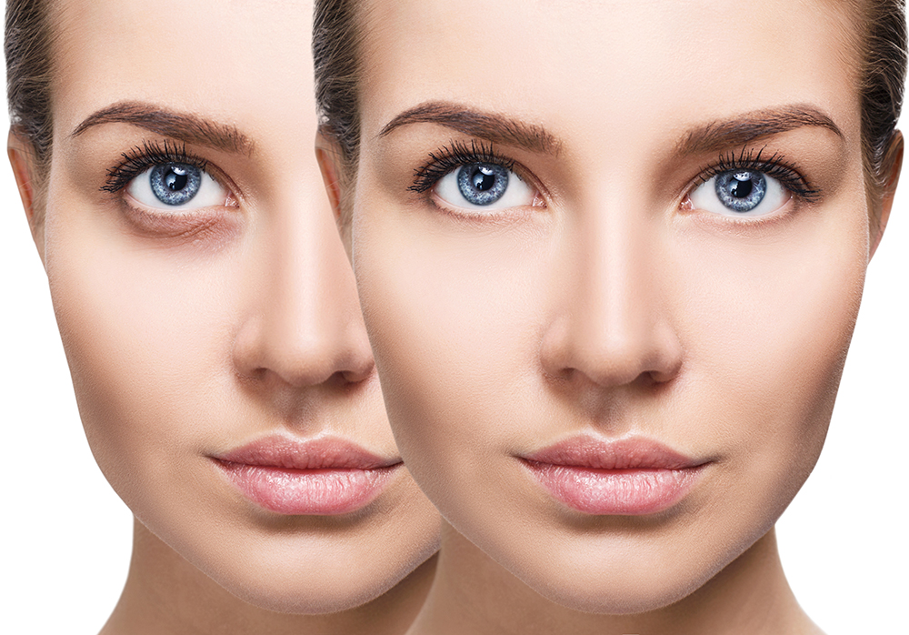 Everything You Need to Know About Eye Fillers