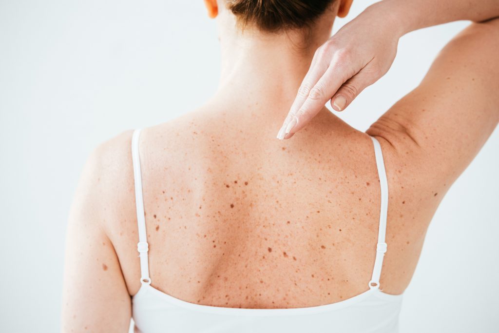 Difficult to see moles are easily spotted during a full body skin exam