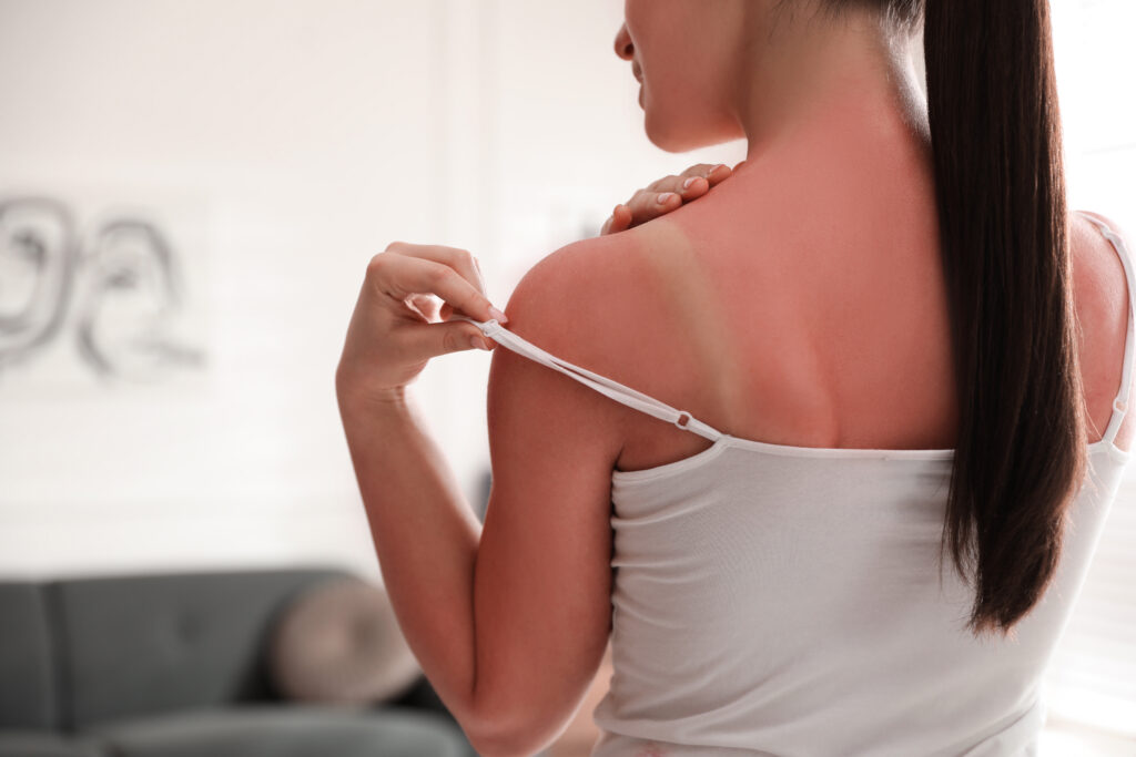 Sunburn Care Skin Cancer & Cosmetic Surgery Center of NJ