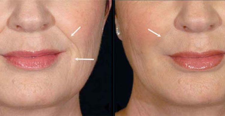 Juvederm vs Restylane