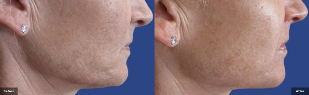 Microneedling Before and After